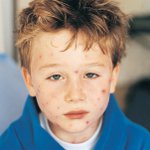Molluscum contagiosum hos børn