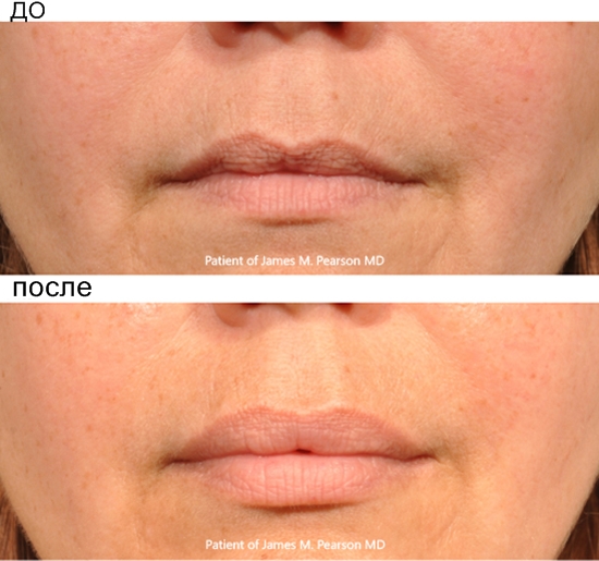 Lip konturplast