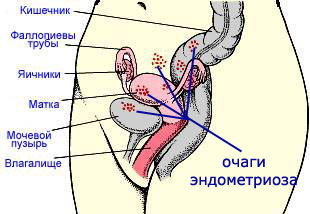 Endometriose: behandling med folkemedicin