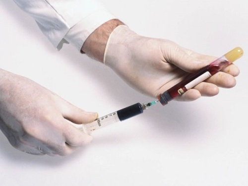 Analyser for antimulylerov et hormon