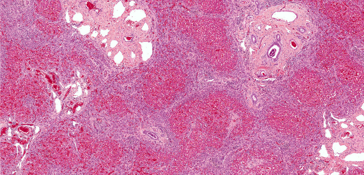 Hvad er fibrose? Symptomer, fotos, behandling