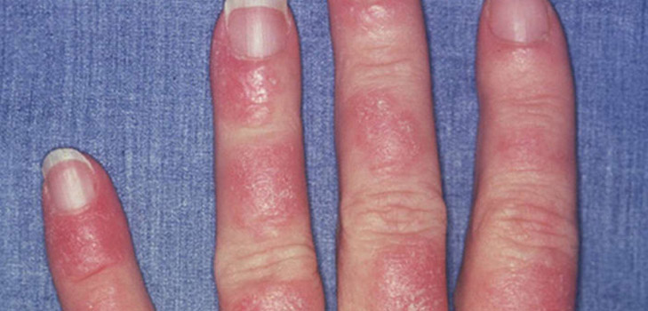 Hvad er lupus? Symptomer og årsager til sygdommen