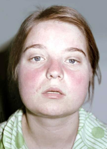 Hvad er lupus? Symptomer og årsager til sygdommen