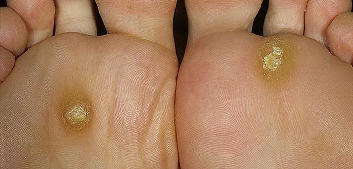 Problemer med corns og calluses? Kig efter løsningen her!
