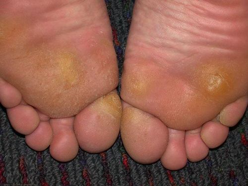 Problemer med corns og calluses? Kig efter løsningen her!