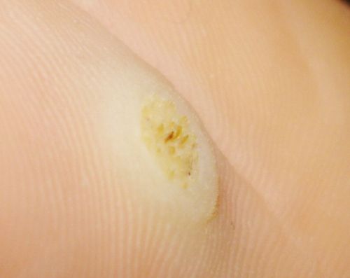 Problemer med corns og calluses? Kig efter løsningen her!