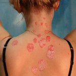 Hvordan man behandler psoriasis? Hvordan man behandler psoriasis?