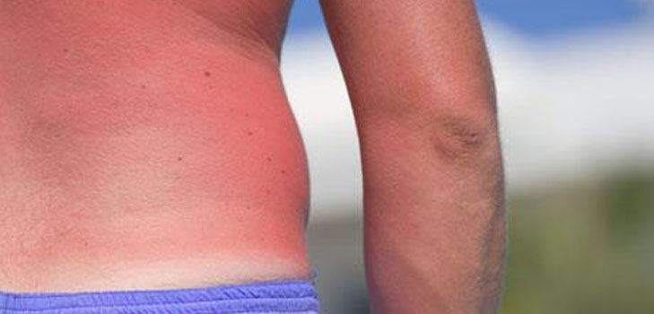 Huden er brændt i solen. Hvad skal jeg gøre? Opskrifter, masker, tips