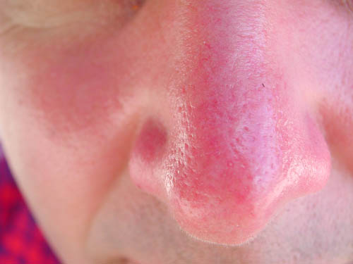 Huden er brændt i solen. Hvad skal jeg gøre? Opskrifter, masker, tips
